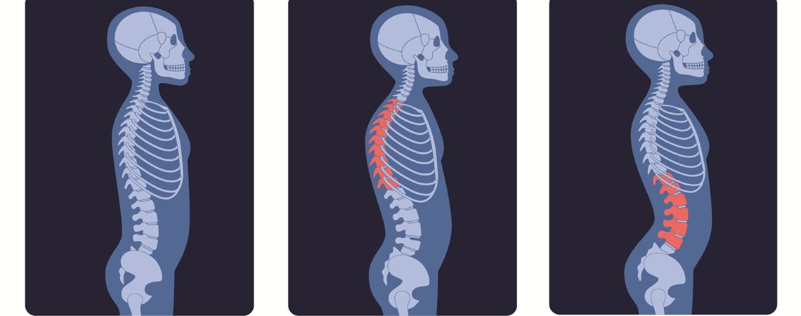 diverse Röntgenaufnahmen (nomal, Kyphose, Lordose)